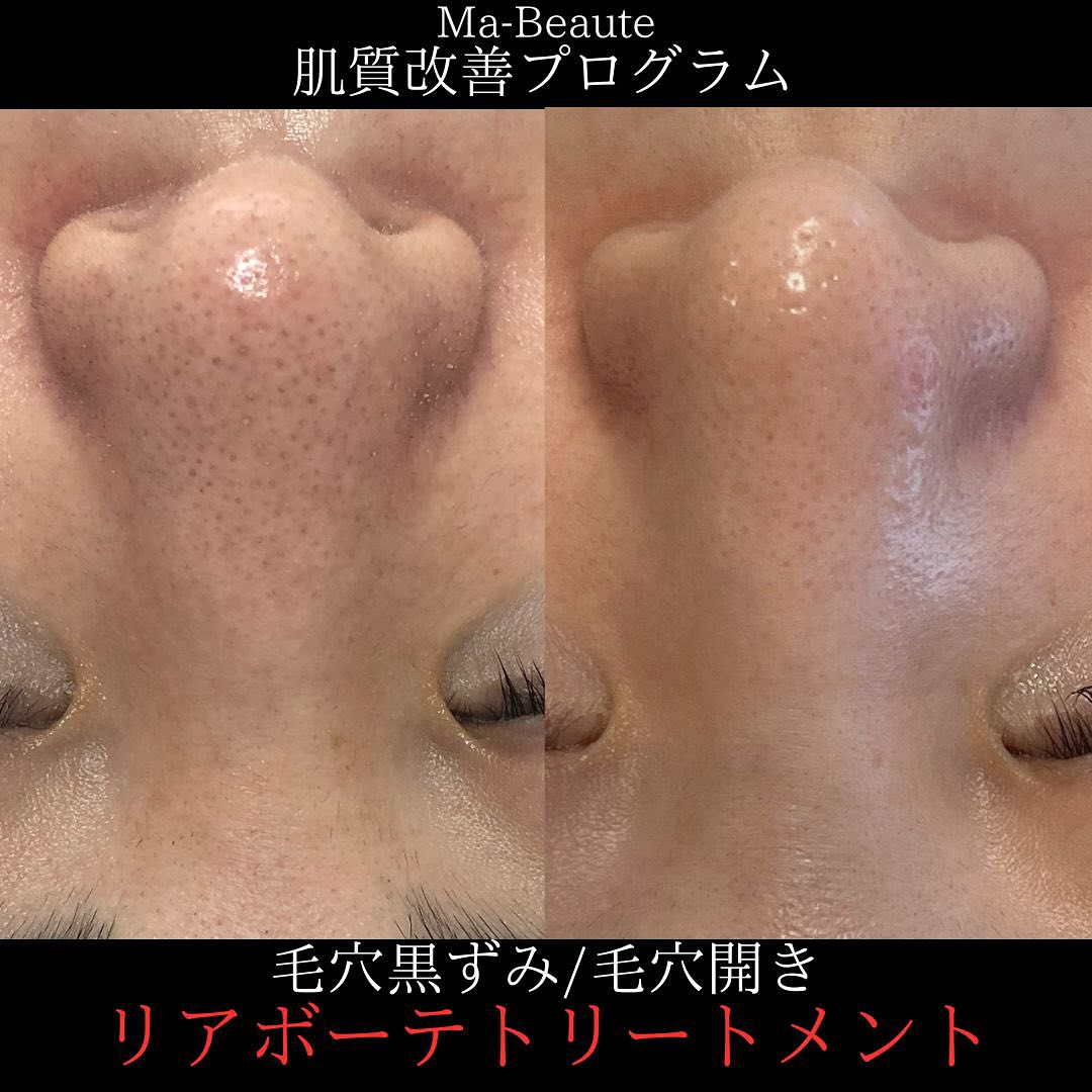 黒ずみ毛穴！リアボーテ恵比寿エステサロンのMa-Beaute...