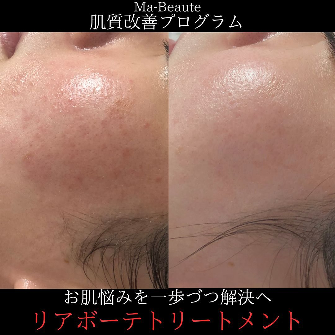 なめらか美肌に！リアボーテ恵比寿エステサロンMa-Beaut...