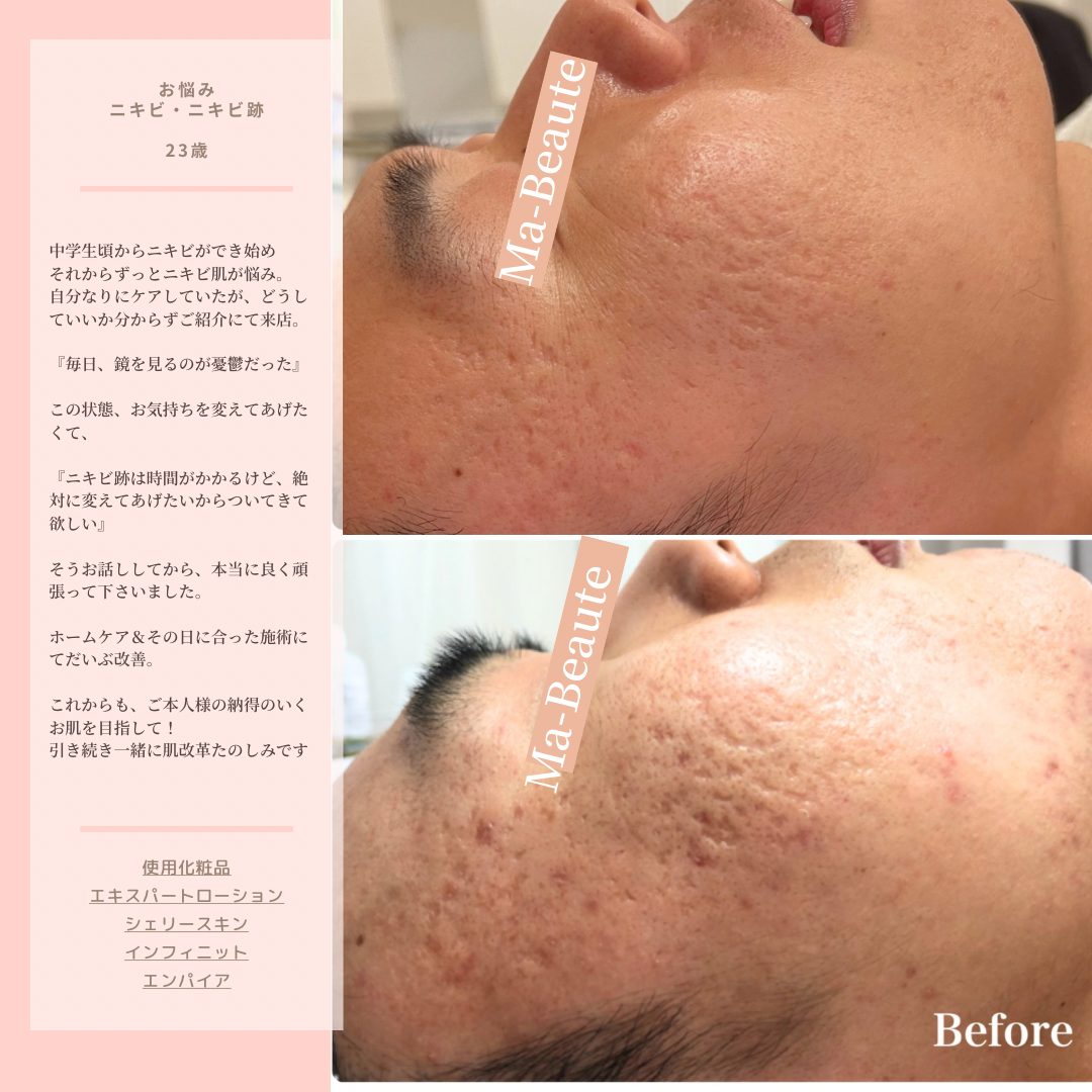 何をしても治らないニキビを無くしたい!長年のニキビ跡も薄くしたい