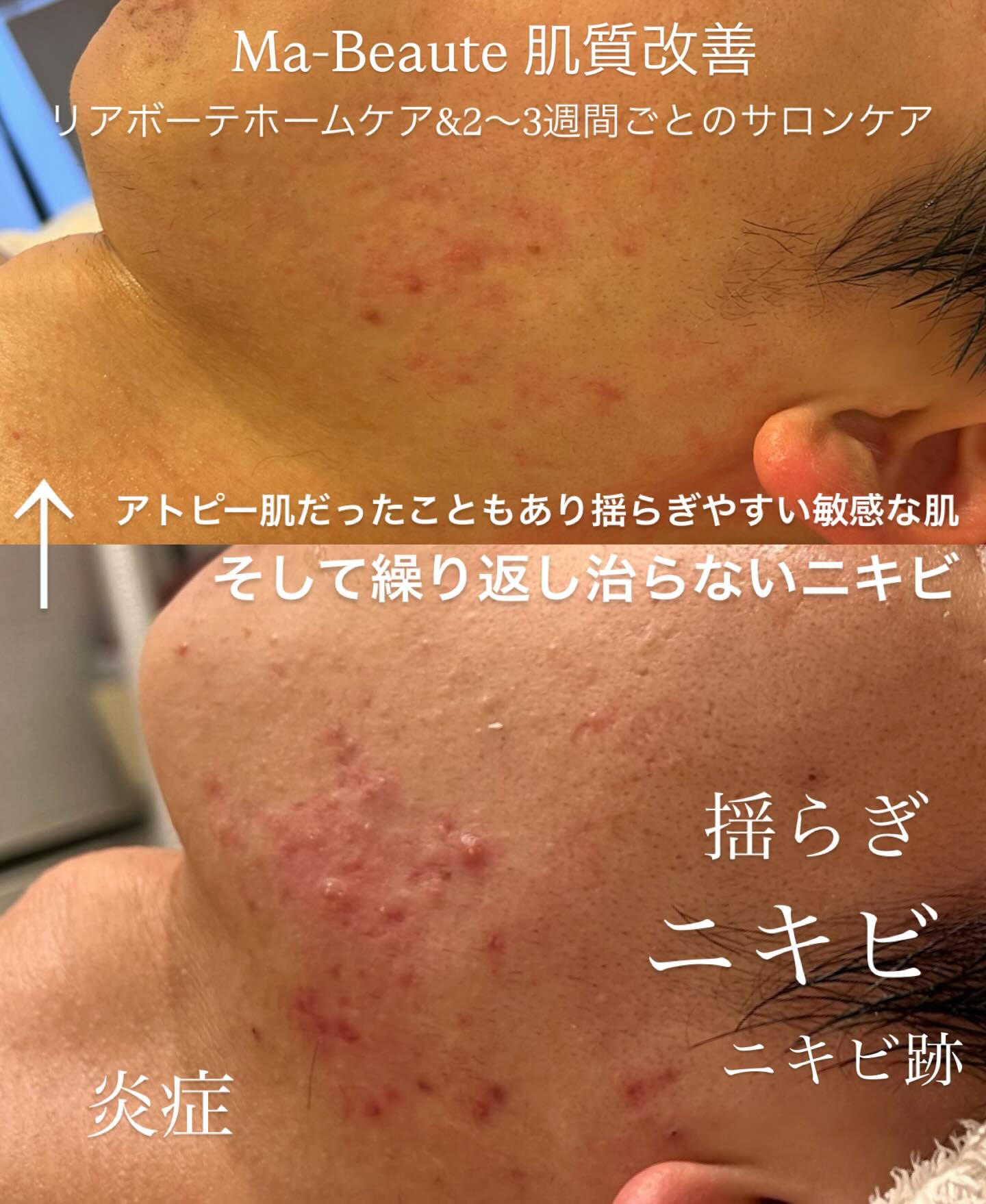 ニキビやニキビ跡、炎症を放っておかない！リアボーテ専門エステ...