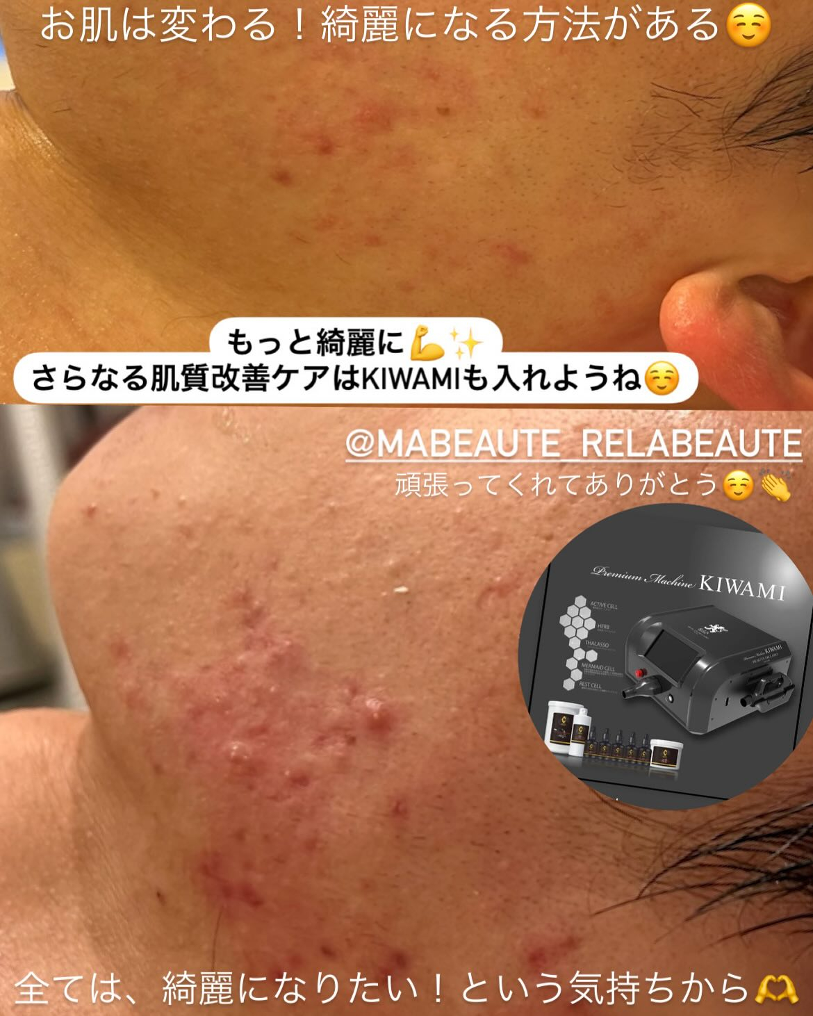 ニキビやニキビ跡、炎症を放っておかない！リアボーテ専門エステ...