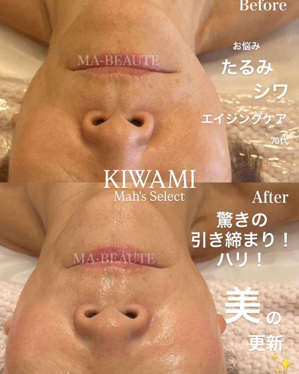 たるみ＆おシワ改善！キュッと引き締め感動の若返り術！