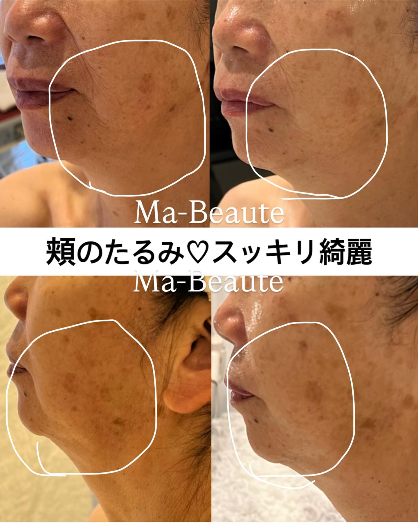 即効小顔！頬のたるみも！おシワもシミも♡鎮静＆肌再生