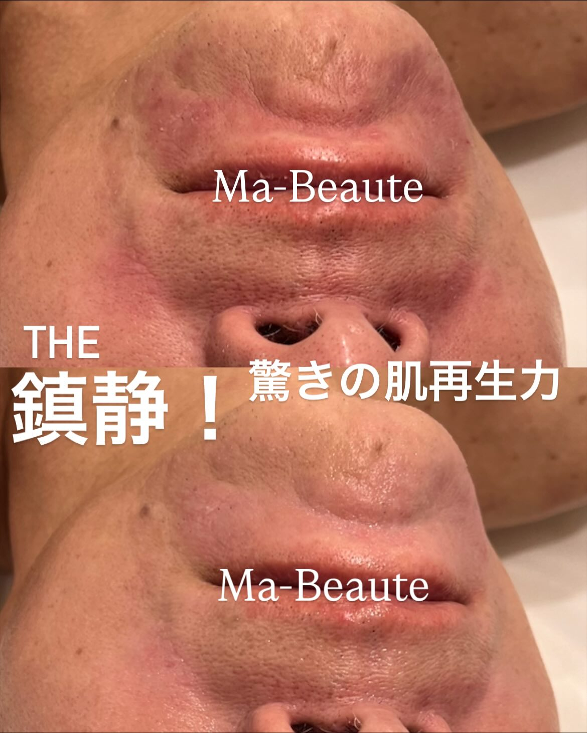 即効小顔！頬のたるみも！おシワもシミも♡鎮静＆肌再生