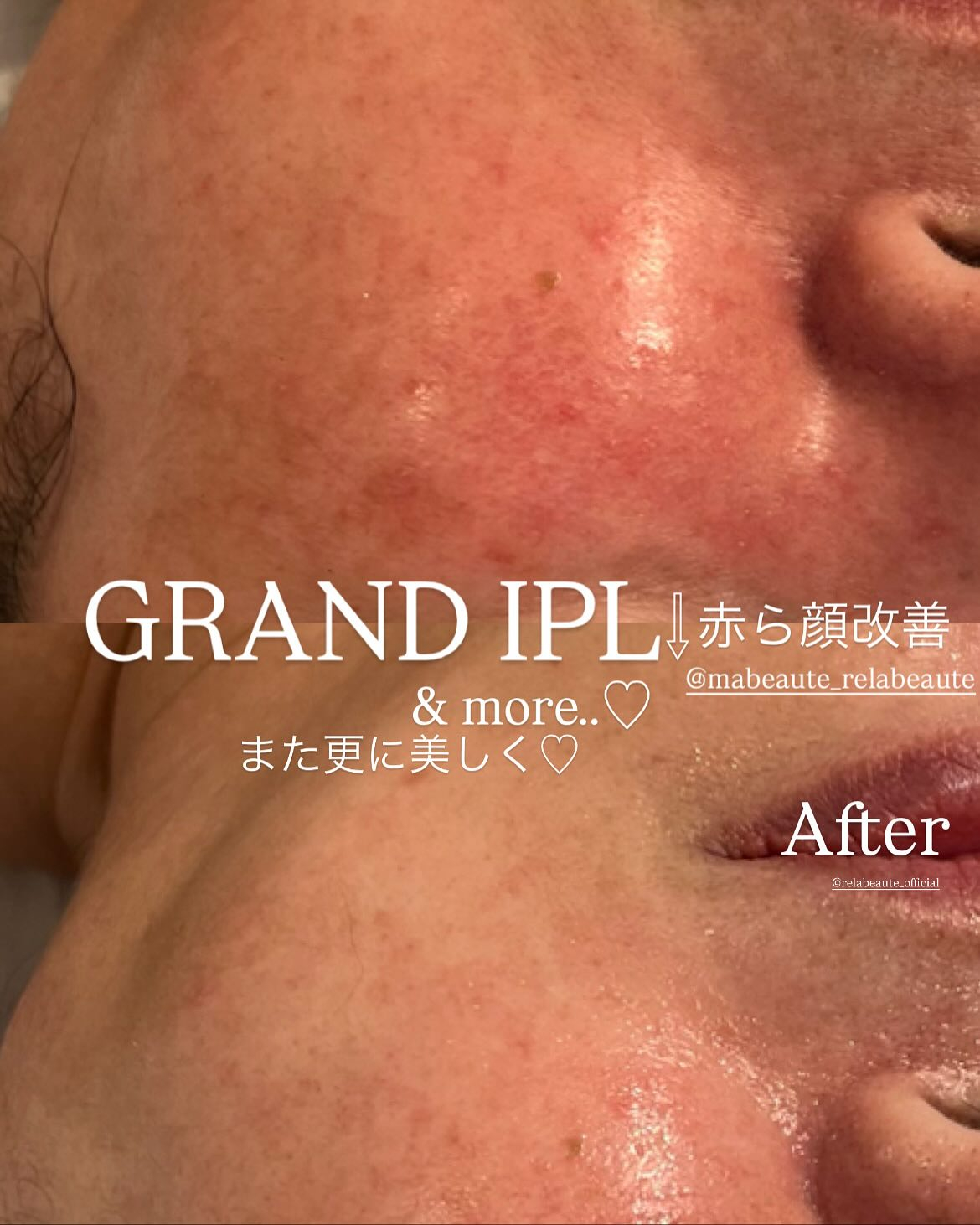 リアボーテKIWAMI❤️最高美肌に仕上げるGRANDIPL...