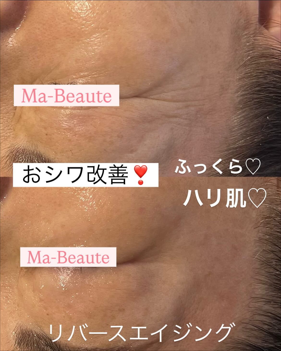 即効小顔！頬のたるみも！おシワもシミも♡鎮静＆肌再生